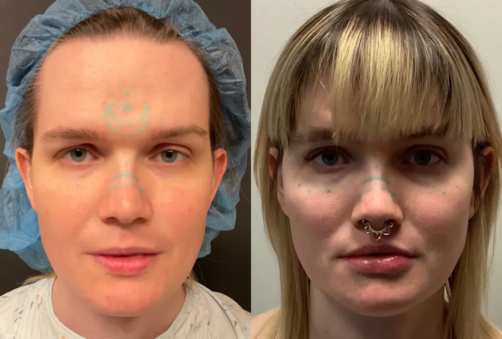 Who Is a Good Candidate for Facial Feminization Surgery?