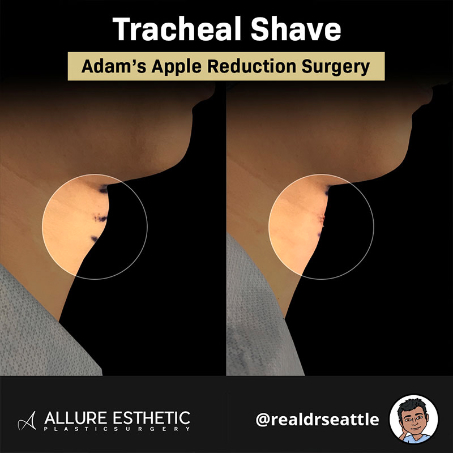 A Before and After Photo of a Tracheal Shave Surgery by Dr. Javad Sajan
