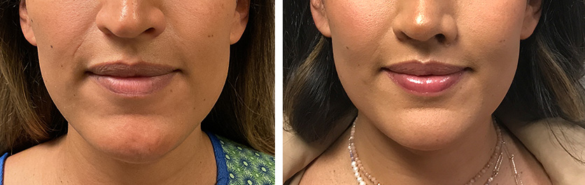 Central-Lip-Lift-before-after-02