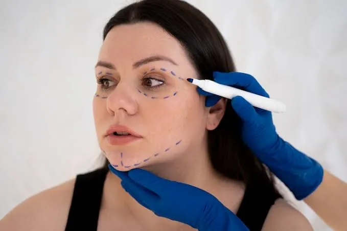 Facial Fat Grafting Cost