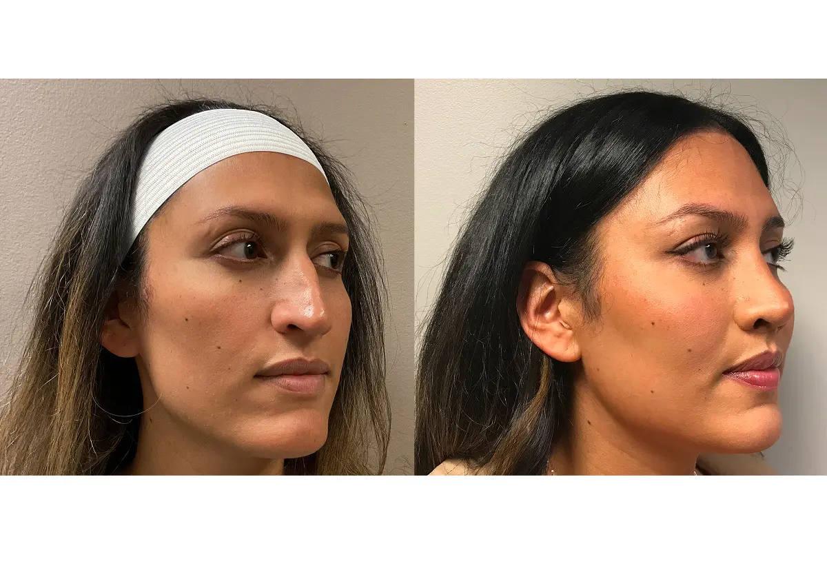 Facial Feminization Surgery