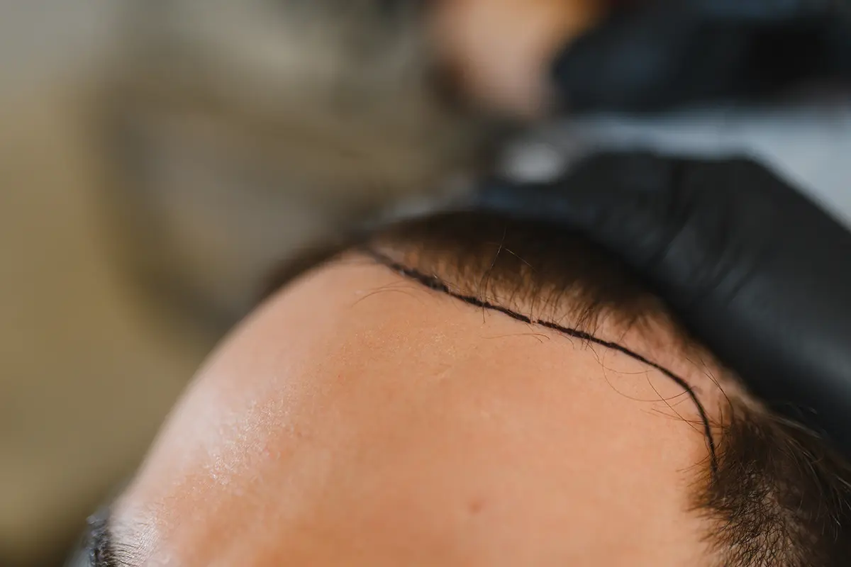 Hairline Lowering Procedure cost