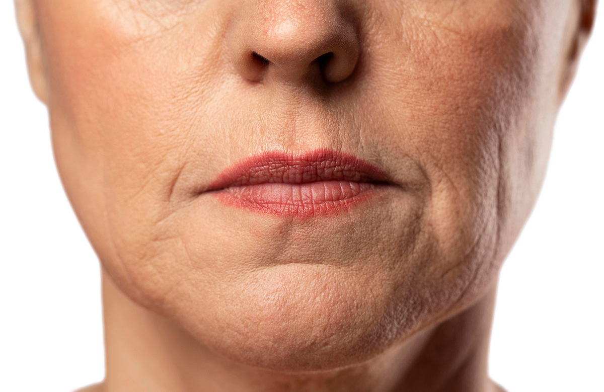 home remedies for upper lip wrinkles