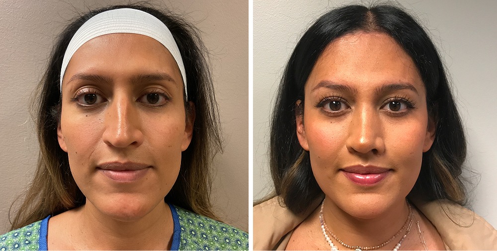 Facial Feminization Surgery Before and After Photos
