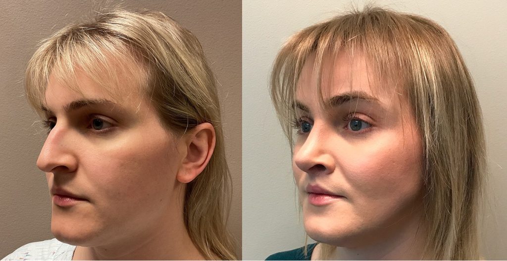 Facial Feminization Surgery Before and After