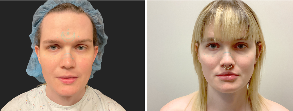 facial feminization before and after photos