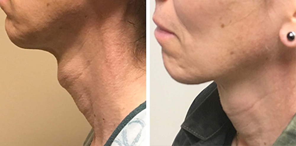 tracheal shave before and after