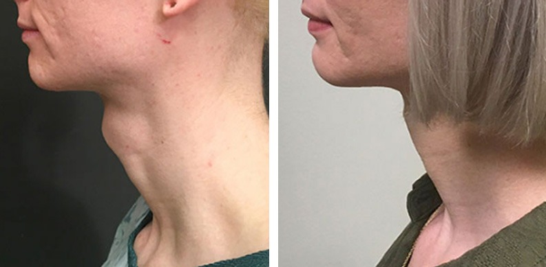 tracheal shave before after photos