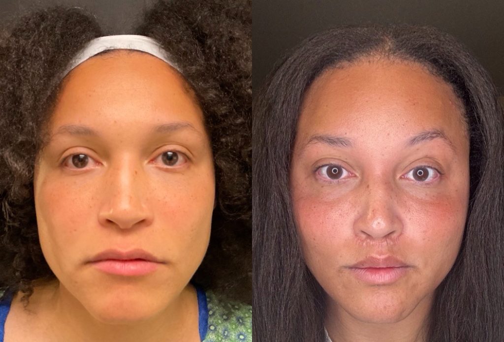 Jawline Feminization Before and After