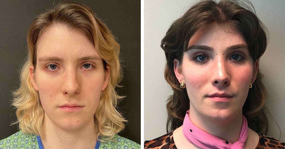 Facial Feminization Surgery Before and After Images