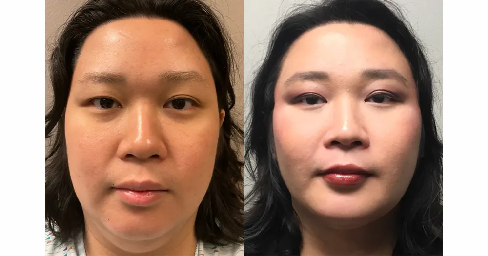 Facial Feminization Surgery Before and After Results