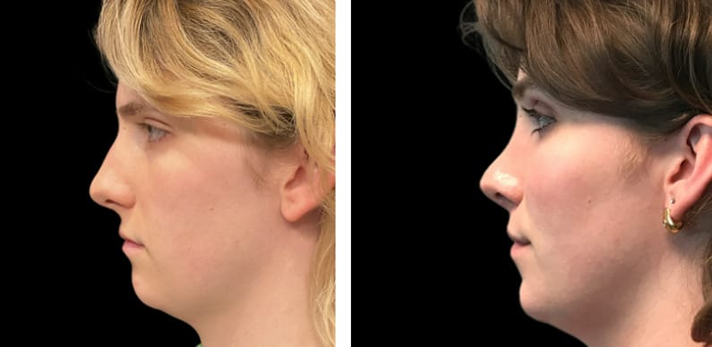 transgender-rhinoplasty-before-after-02